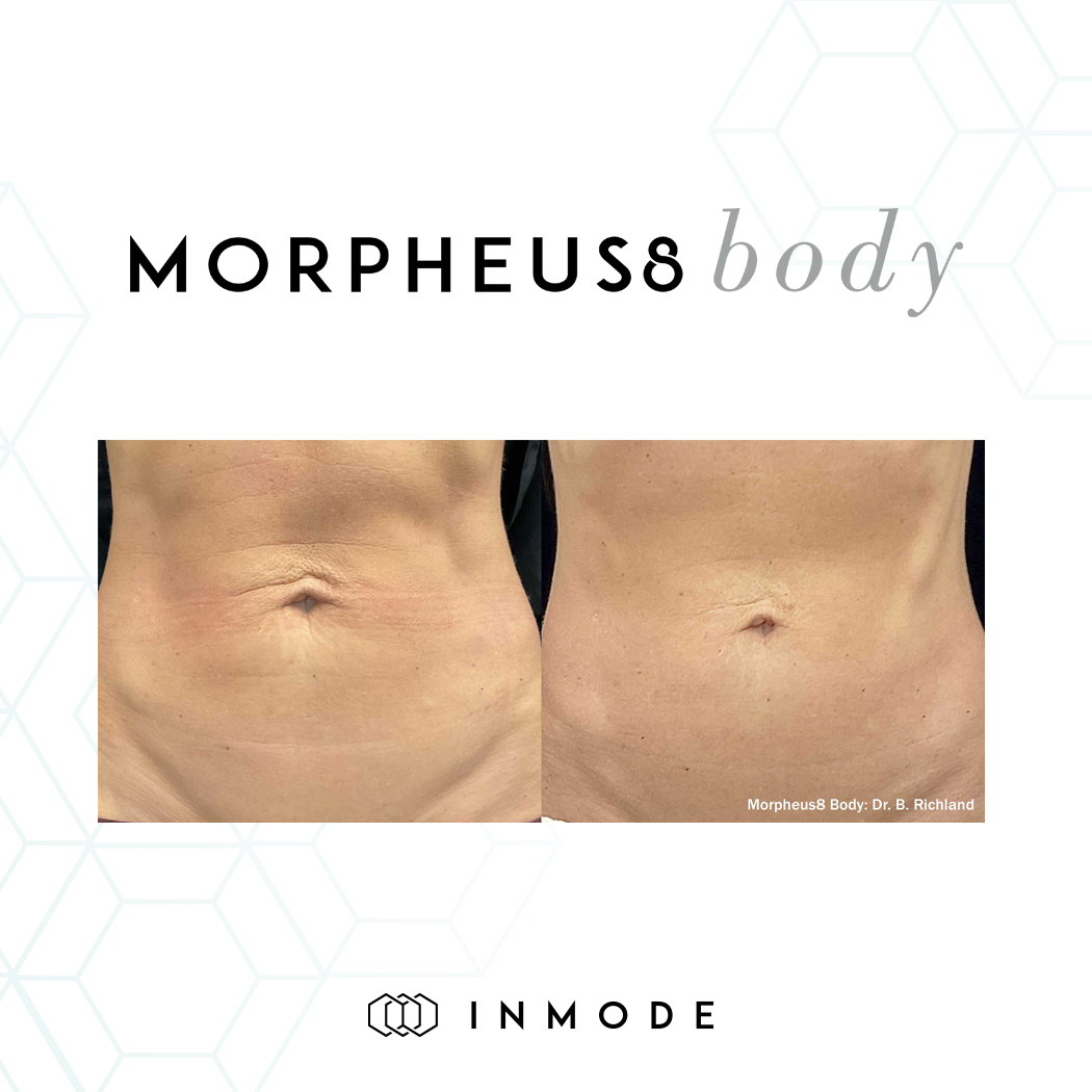 Morpheus8 before and after