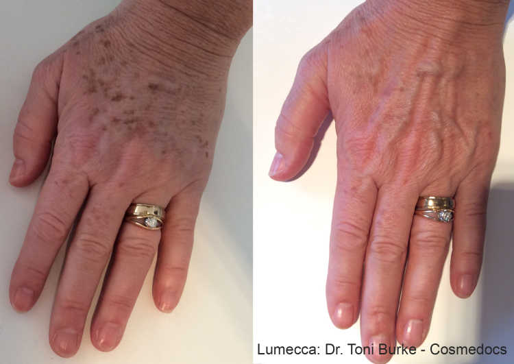 Lumecca before and after — hands