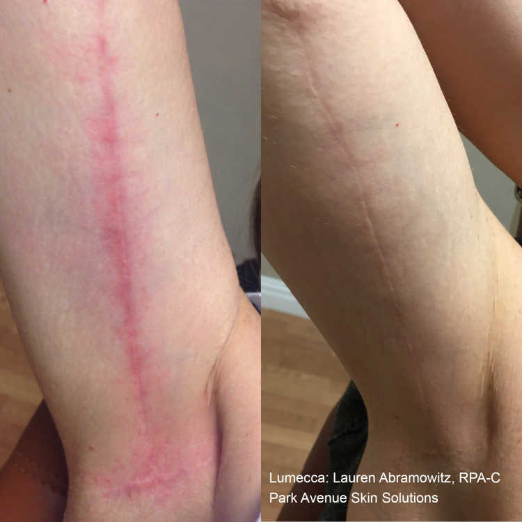 Lumecca before and after — skin closeup