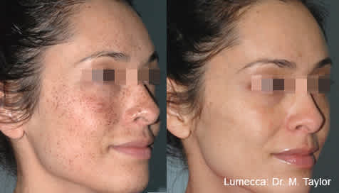 Lumecca before and after — face