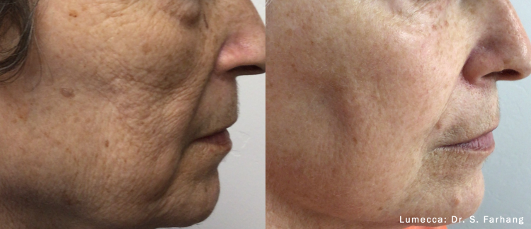 Lumecca photofacial caption
