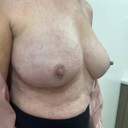 Hidden scar right nipple-sparing mastectomy under breast 2 wks