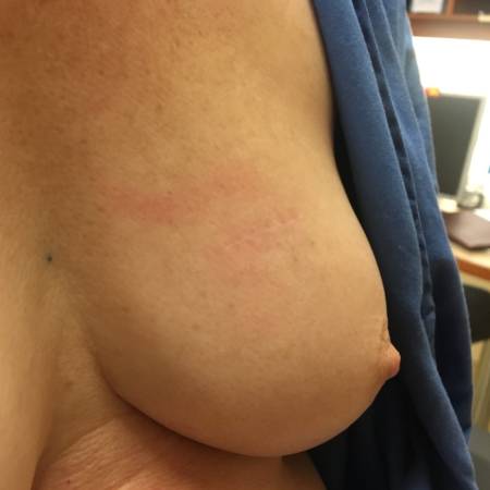 Left lumpectomy upper inner incision 6 mo
