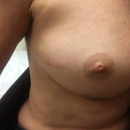 Right lumpectomy lateral (side) incision 6 mo