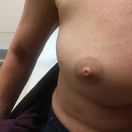 Right lumpectomy lateral (side) incision 6 mo
