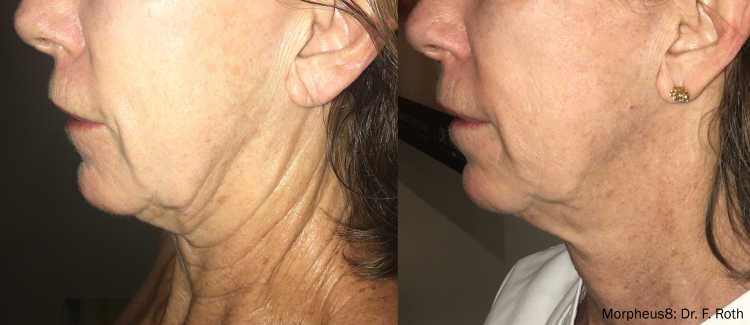 Morpheus8 before and after