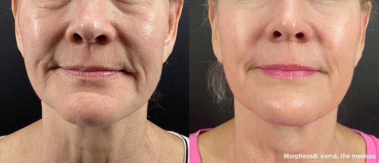 Morpheus8 before and after