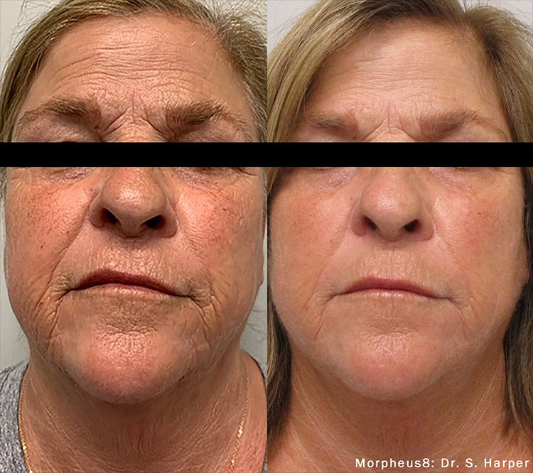 Morpheus8 before and after