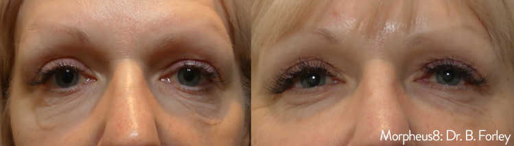 Morpheus8 before and after