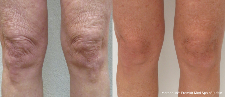 Morpheus8 before and after