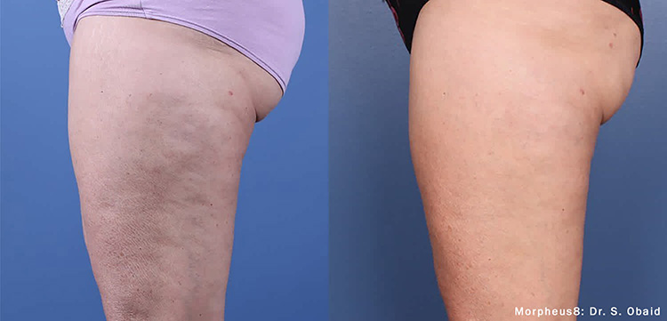 Morpheus8 before and after