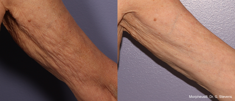Morpheus8 before and after