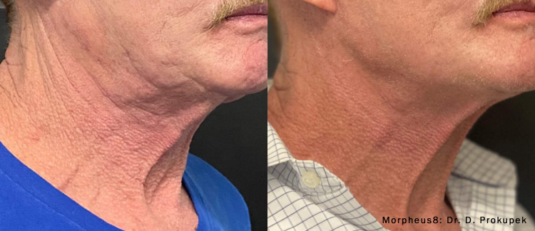 Morpheus8 before and after